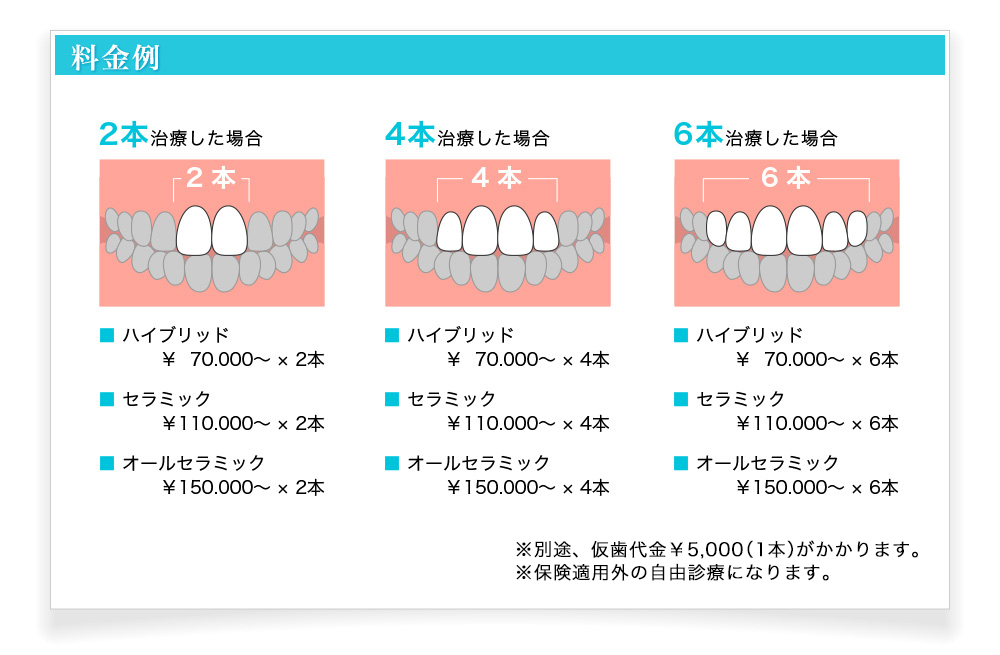 料金例　2本治療した場合 ■ハイブリッド￥70.000～ × 2本 ■セラミック ￥110.000～ × 2本 ■オールセラミック ￥150.000～ × 2本　4本治療した場合 ■ハイブリッド￥70.000～ × 4本 ■セラミック￥110.000～ × 4本 ■オールセラミック￥150.000～ × 4本　6本治療した場合 ■ハイブリッド￥70.000～ × 6本 ■セラミック￥110.000～ × 6本 ■オールセラミック￥150.000～ × 6本　※別途、仮歯代金￥5,000（1本）がかかります。※理事長を指名しない場合は最大20％OFF